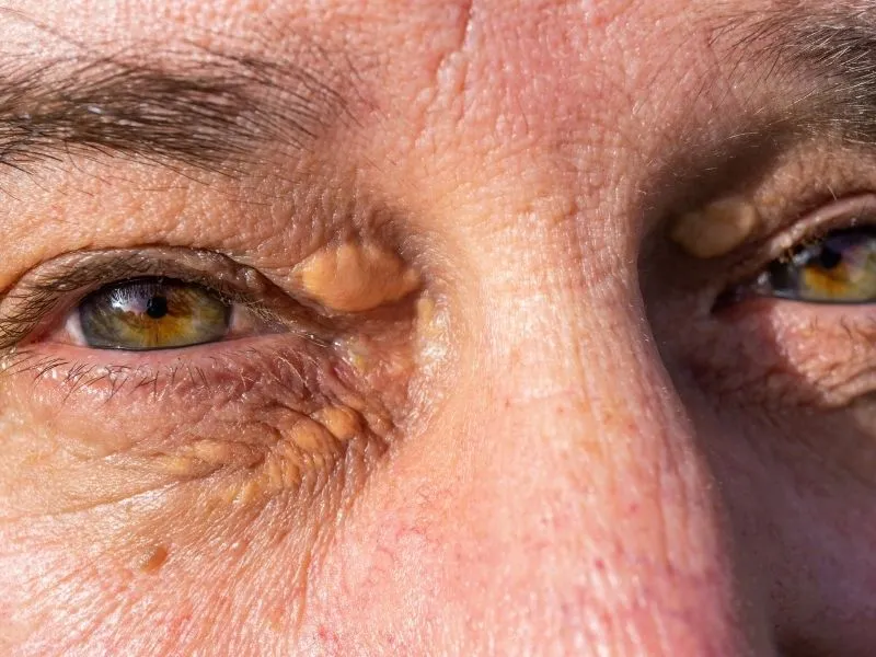 Hipercolesterolemia Familiar: a doença genética do colesterol que mata antes dos 50 anos — e ainda é amplamente desconhecida