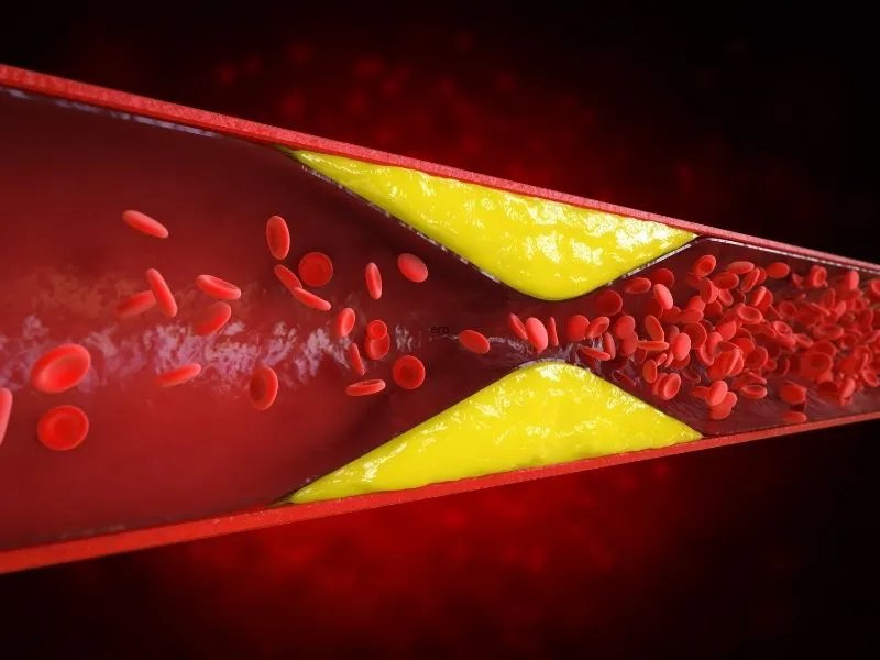 Aterosclerose: Como as Placas se Formam Antes do Infarto